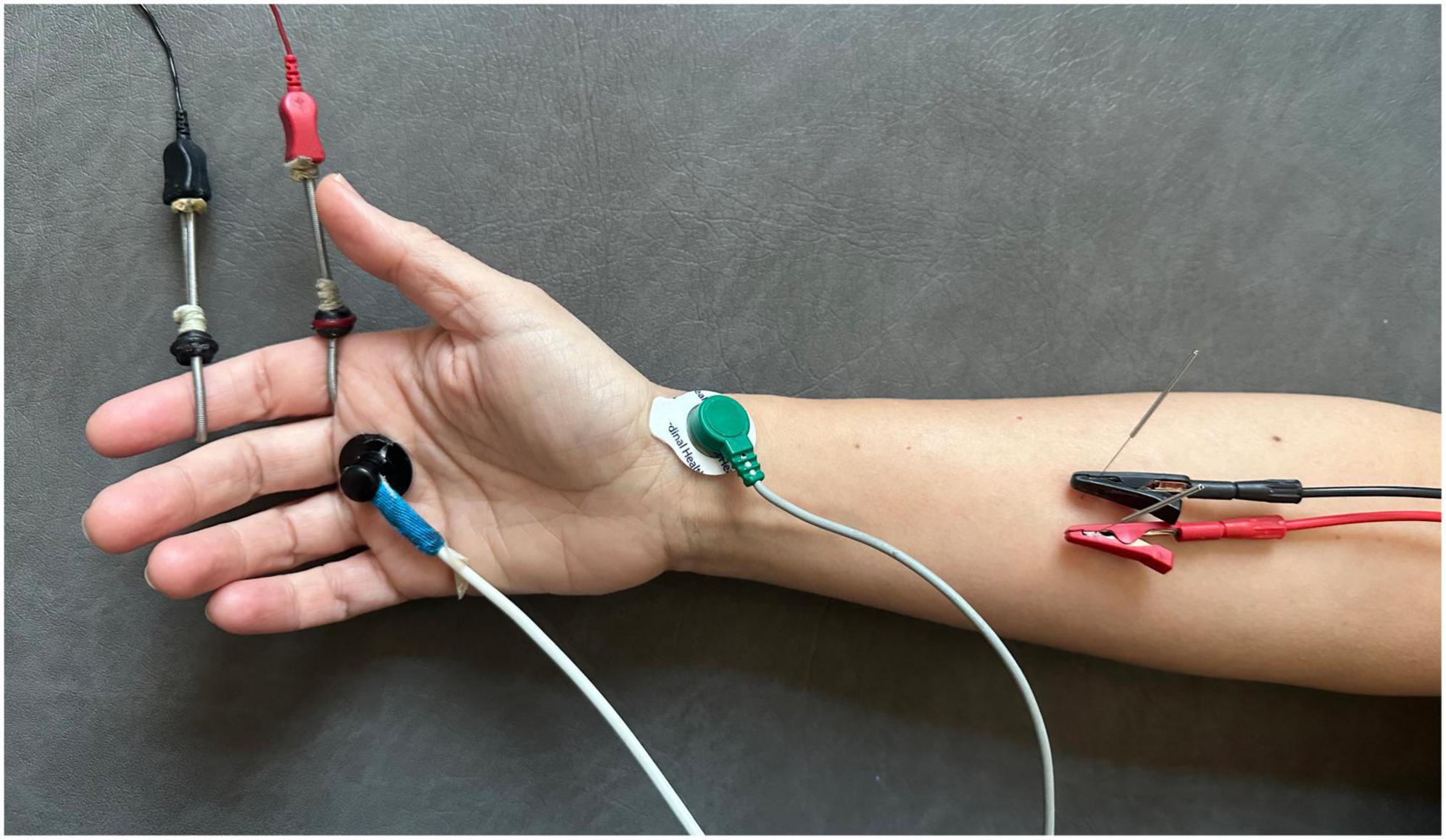Effect of percutaneous electrical stimulation with high-frequency alternating currents at 30 kHz on the sensory-motor system